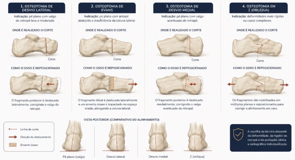 Ilustração comparativa das diferentes osteotomias do calcâneo para tratamento do pé plano, mostrando onde o corte é realizado e como o osso é reposicionado em cada técnica.